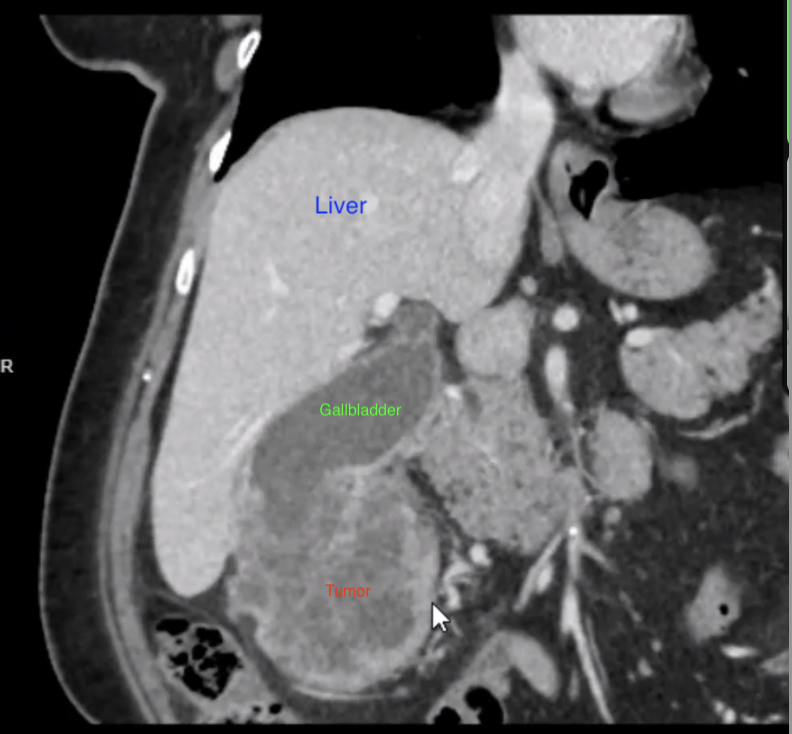 CT Scan showing gallbladder cancer tumor